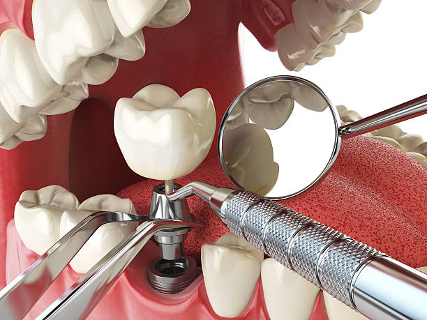 Best Emergency Dentist for Lost Fillings or Crowns in Rose Hill, NC